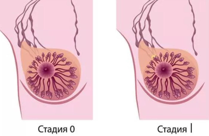Лечение рака молочной железы 1 стадии 