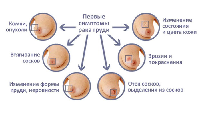 Лечение paка молочной железы: обзор методов, прогноз по стадиям 