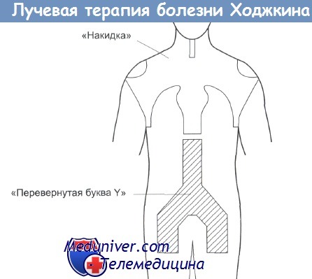 Лучевая терапия лимфомы Ходжкина 