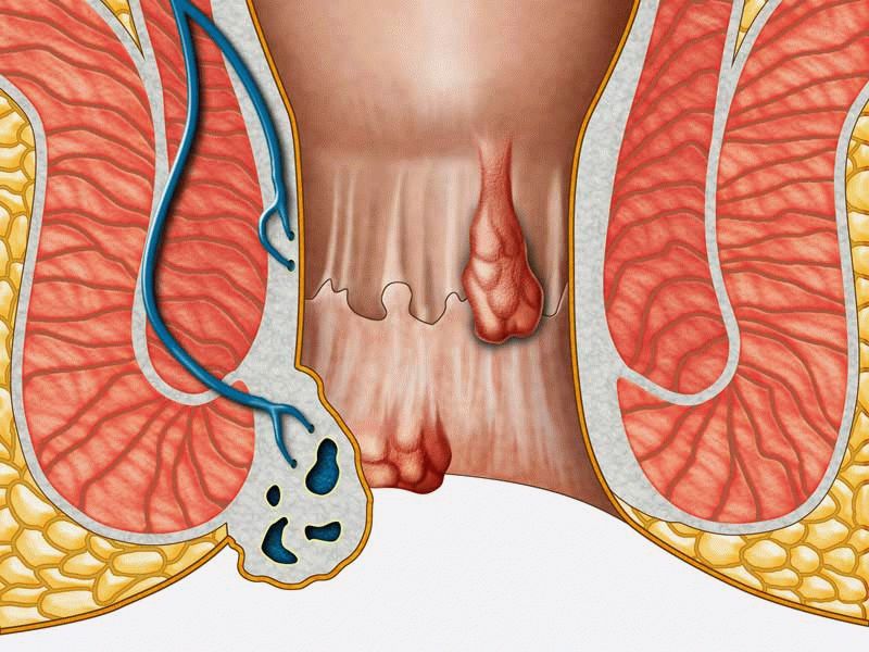 Может ли paк быть последствием геморроя? 