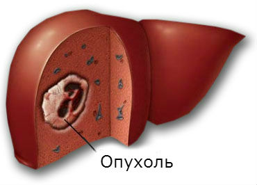 Опухоли печени: симптомы, виды и лечение 
