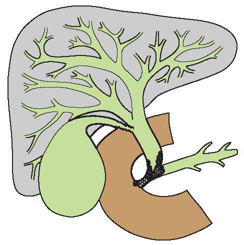 Опухоль Клацкина (Клатскина) или воротная хоалнгиокарцинома 