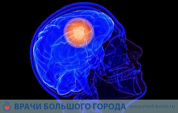 Опухоль мозга глиобластома 
