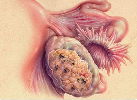 Опухоль яичников: удаление и прогноз выживаемости 1-4 стадии, рецидив 