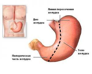 Осложнения резекция желудка 