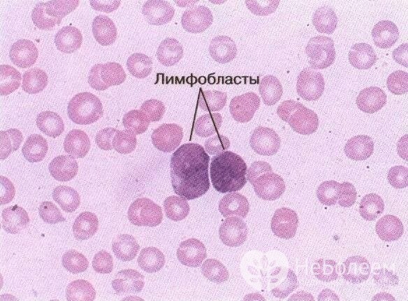 Особенности протекания и лечения острого лимфобластного лейкоза у детей 