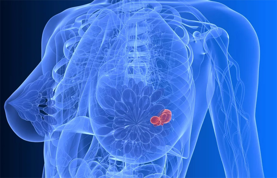 Первые признаки рака груди у женщин: симптомы и диагностика 