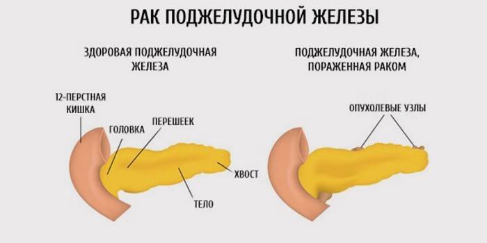 Первые симптомы и признаки paка поджелудочной железы 