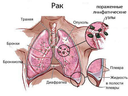 Первые симптомы paка бронхов 