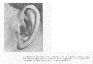 Первый признак рака уха редко заметен 