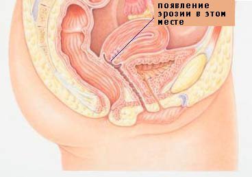 Эрозия шейки матки: современные методы лечения 