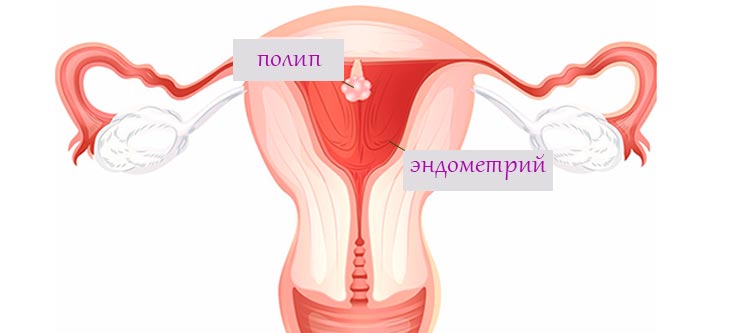 Полип эндометрия в матке 