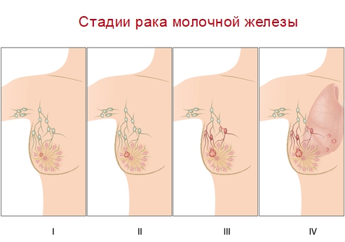 Протоковый paк молочной железы: причины возникновения, симптомы и диагностика 