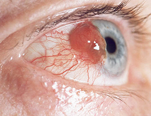 Рак глаза: фото, первые симптомы, лечение 