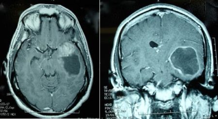 Рак головного мозга 4 степени 