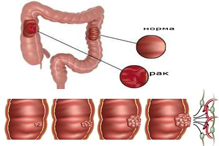 Рак кишечника — признаки, симптомы на ранних стадиях, лечение и прогноз 