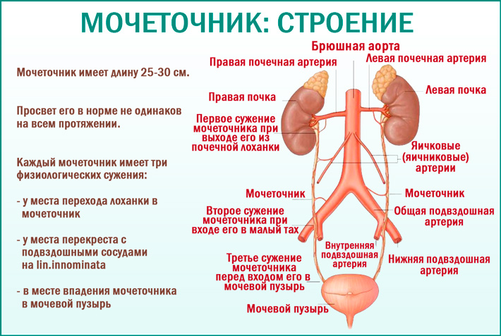 Рак мочеточника 