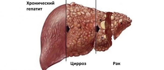 Рак печени 4 стадии с метастазами — прогноз и лечение 