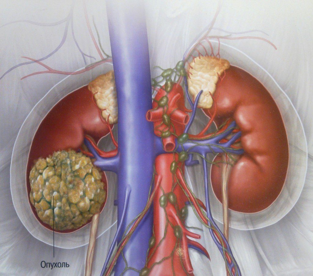 Рак почки: код по МКБ 10 