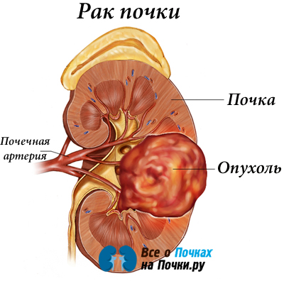 Рак почки у мужчин и женщин: жизнь продолжается 