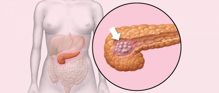 Рак поджелудочной железы 4 стадии 