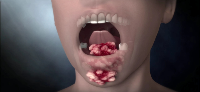 Рак полости рта: насколько и когда эффективно лечение? 