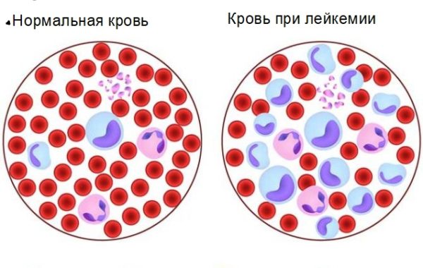 Симптомы и лечение хронического лейкоза 