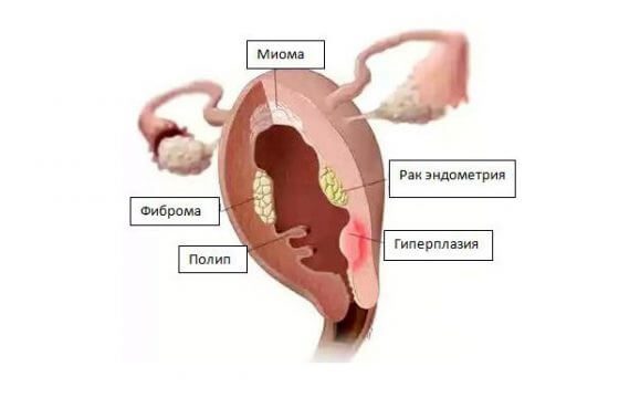 Симптомы опухоли матки: что и почему происходит? 