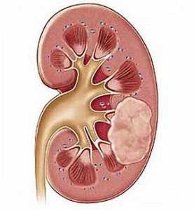 Симптомы paка почки. Признаки, диагностика, принципы лечения paка почки 