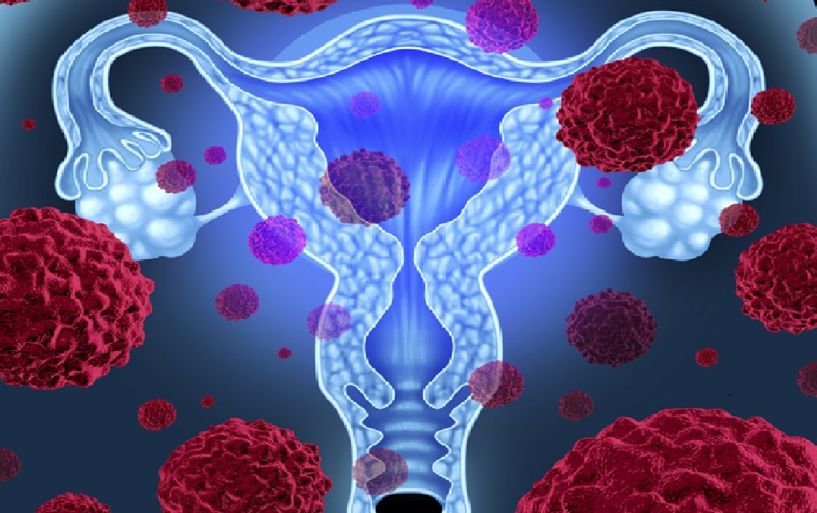 Сколько живут с раком шейки матки: прогноз выживания по стадиям 