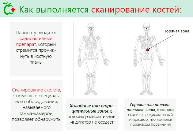 Сцинтиграфия при paке 