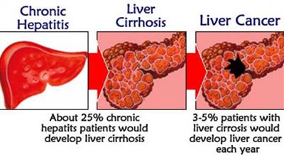 Цирроз печени - это paк или нет? 