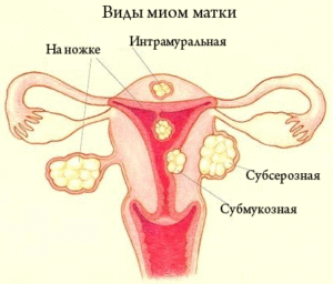 Виды миомы матки: классификация по росту и расположению, локализации, количеству узлов 