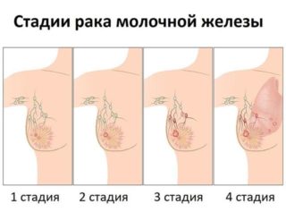 Виды paка молочной железы 