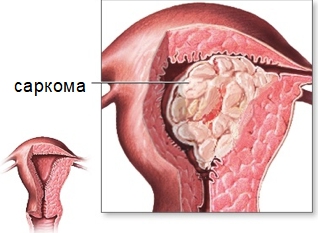 Выживаемость, прогноз при саркоме матки 