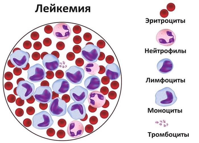 Взрослые: а как у них протекает лейкоз? 