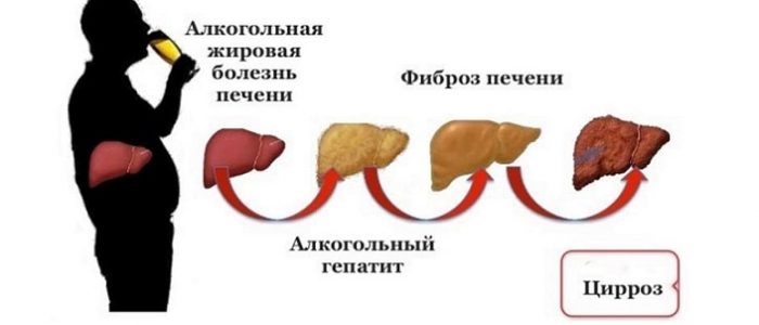 Алкогольная болезнь печени: признаки и симптомы, лечение 