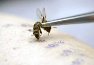 Апитерапия – лечение укусами пчел 