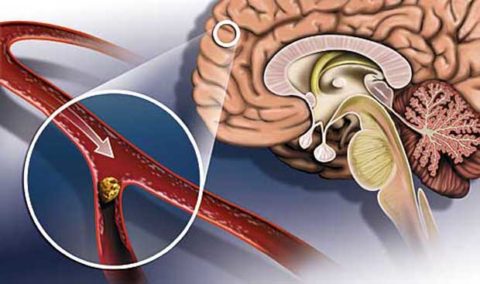 Атеросклеротическое сужение сосудов головы и шеи: возникновение, признаки, лечение 