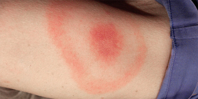 Болезни от укуса клеща: 7 заболеваний переносимых клещами 