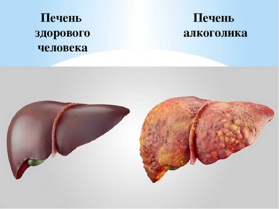 Что происходит с печенью при употрeблении алкоголя 