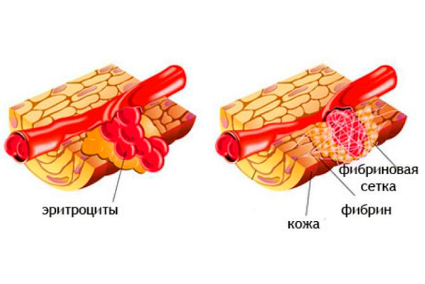 Фибриноген при беременности 