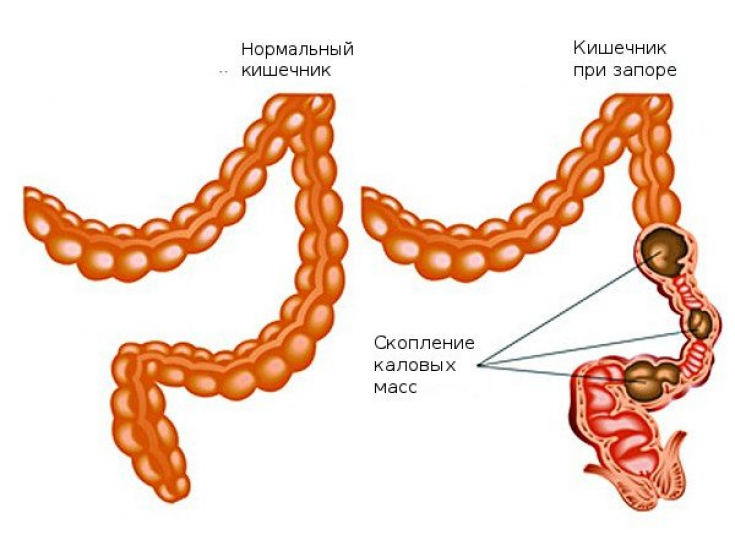 Диета для очищения кишечника — вкусное меню для похудения за 10 дней 