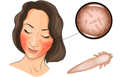 Как лечить демодекоз на лице 