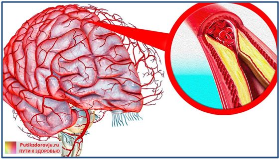 Как почистить сосуды головного мозга народными средствами 
