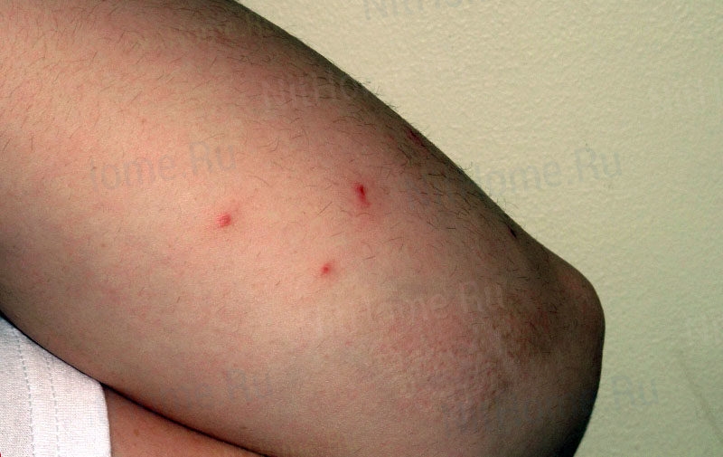 Как выглядят укусы клопов на коже человека: признаки, размеры, симптомы, фото 