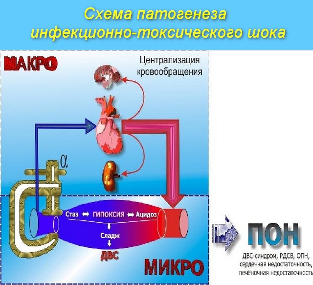 Неотложная помощь при инфекционно-токсическом шоке у ребенка 