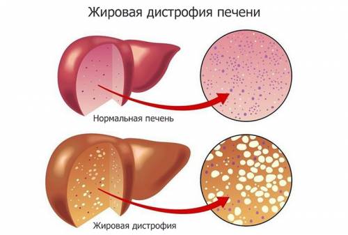 Почему жировая дистрофия печени нелегко поддается лечению? 