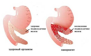 Причины резей в животе. Что делать при рези? 