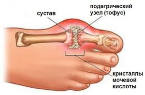 При подагре можно ли принимать кардиомагнил 